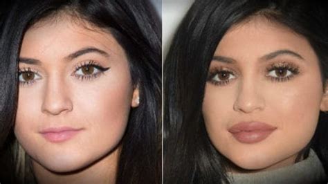 Cosmetic surgery of lips