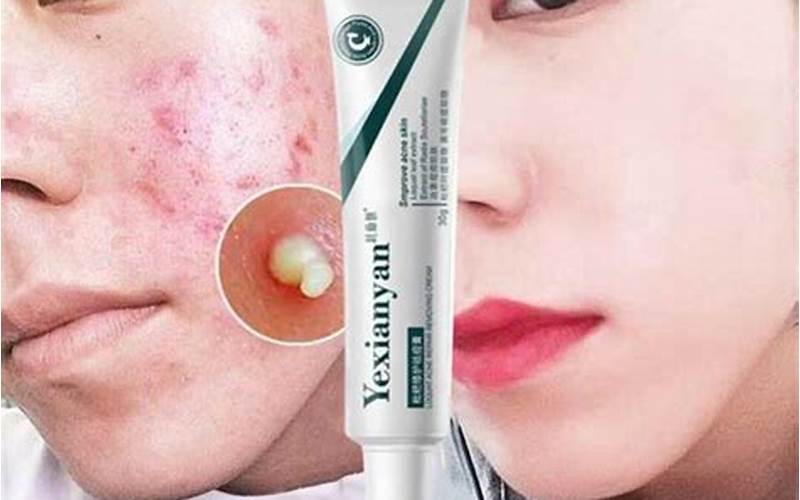 Cream Acnes Penghilang Bekas Jerawat