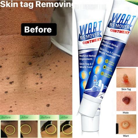 Magical Elixir: Banish Skin Imperfections with Cream for Skin Tags