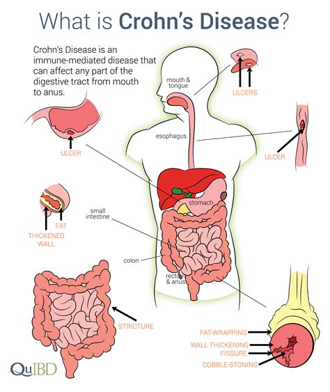 What are the first signs of Crohn's disease? North Shore Gastro