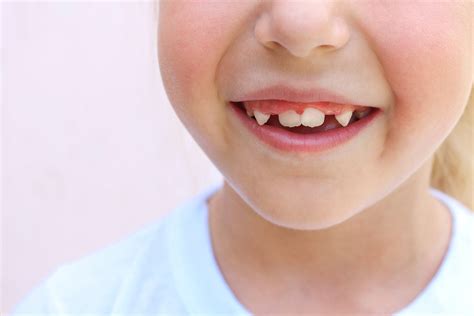 Crooked or misaligned teeth in a child's mouth