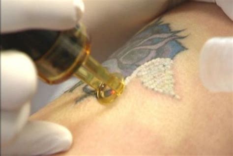 Laser Tattoo Removal Treatment in Dubai Permanent Tattoo
