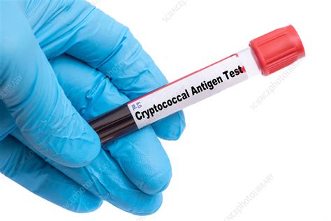 Cryptococcal Antigen Test and interpretation