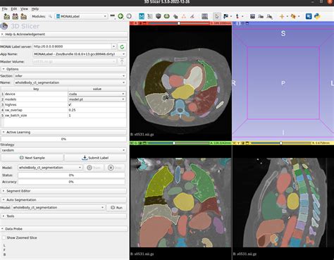 The Ultimate Guide to Precision Clinical Diagnostics: Discover the Power of CT Image Segmentation Software for Accurate and Efficient Analysis
