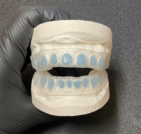 Custom Whitening Trays: Speed and Control