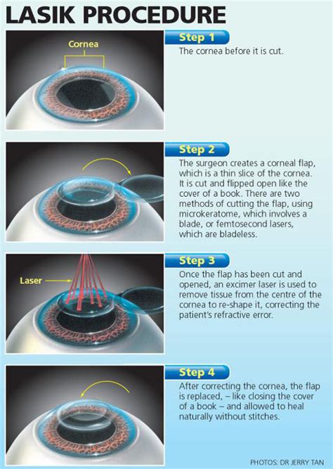 Customizing Your LASIK Experience