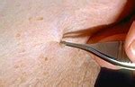 Say Goodbye to Unsightly Skin Tags with Cutting-Edge Domain_10 Techniques!