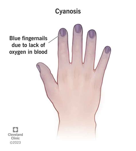 Cyanosis