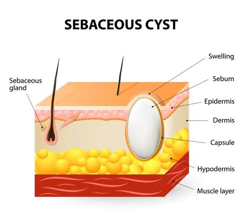 Cyst Removal: Effective Methods & Solutions