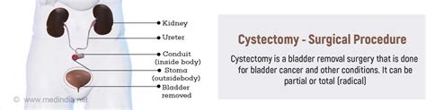 Cystectomy: Options, Recovery & Life After Surgery