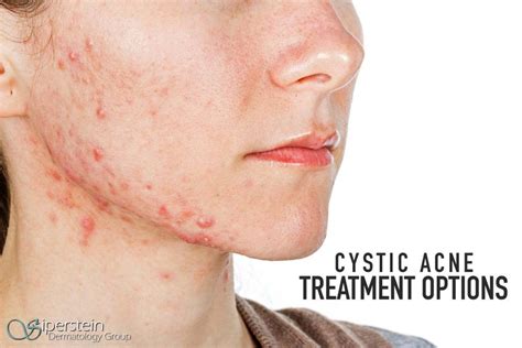 Acne Cystic Natural Treatment Acne Face Scars