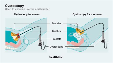 Cystoscopy: Relief, Recovery, & What to Expect.