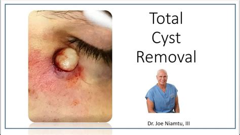 Cysts: Risks, Removal & Protecting Your Health