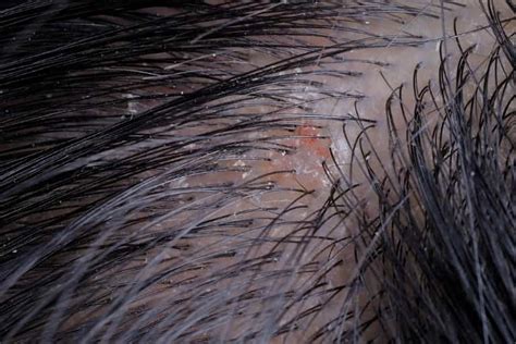 Dandruff & Hair Loss: Effective Solutions Now.