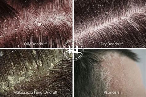 Dandruff Types & Effective Treatment Solutions