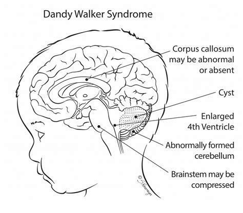 References in Successful Treatment of DandyWalker Syndrome by