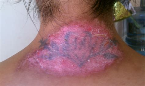 Dangers of laser tattoo removal? Another Halloween walkin