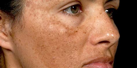Darker Skin Spots On Your Face: Causes And Treatment Options