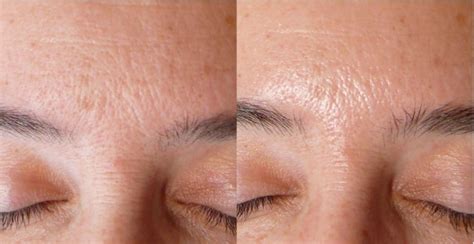 Unveiling the Hidden Truth: Visual Aids of Dead Skin Cells on Face and Effective Ways to Eliminate Them