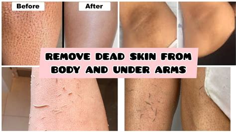 Say Goodbye to Your Dead Skin! Learn How to Remove Excess Sebum, Dirt and Dead Skin on Your Back with These Simple Steps