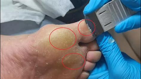 Say Goodbye to Embarrassing Dead Skin on Your Feet: Reveal Smoother and Happier Feet in Minutes