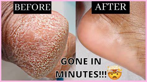 Revive Your Feet: Discover the Secret to Softer Skin with Revolutionary Dead Skin Removal Treatment