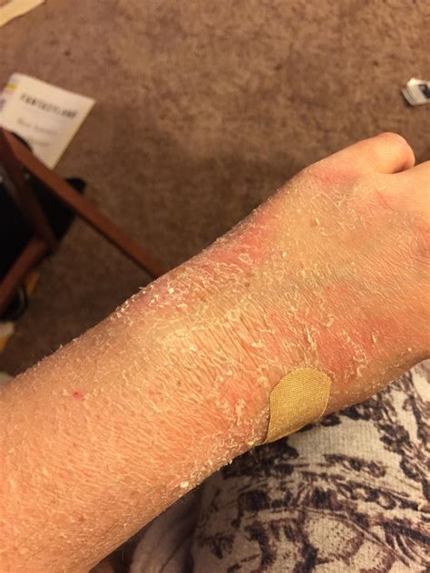 Banish Dead Skin Trapped Under Cast: Ultimate Guide to Revitalize Your Skin