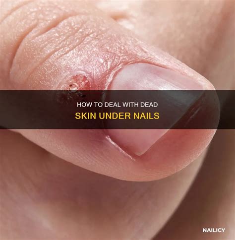 Gone but not Forgotten: Discover the Unseen World of Dead Skin Under Nails!