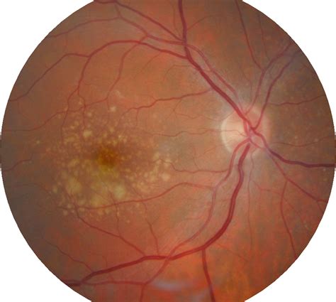 Dealing with Glaucoma and Retinal Conditions