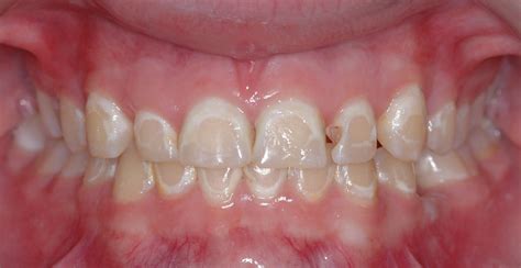 Decalcification after Braces