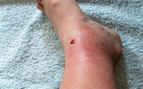 Deep Wounds and Puncture Marks