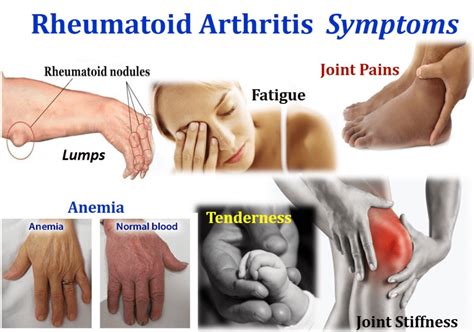 Defining Arthritis