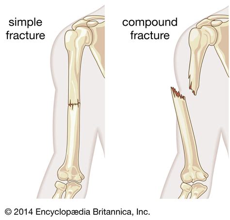 The Ultimate Guide to Understanding Compound Fractures: A Comprehensive Definition and Explanation