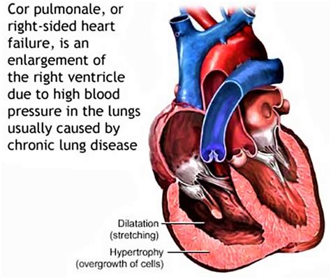 Pump Up Your Knowledge: A Comprehensive Guide to the Definition and Causes of Cor Pulmonale