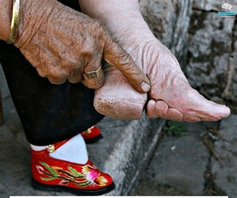 Uncovering the Ancient and Painful Practice of Foot Binding