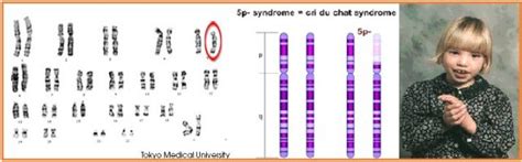 Delesi Lengan Pendek pada Kromosom Nomor 5 Dapat Menyebabkan Sindrom
