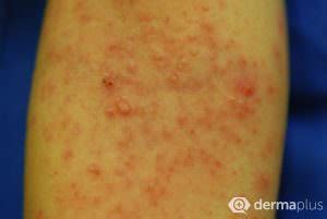 Dellwarzen Bilder Endstadium