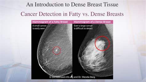 Dense Breasts: What This Means for Screening