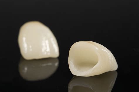 Dental Crowns Cost Metal vs Porcelain
