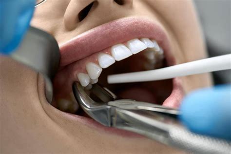 Dental Extraction Cost