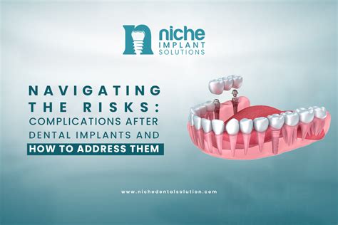 Dental Implants: Process, Risks & Successful Smiles.