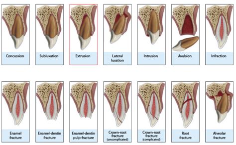 Dental Injuries