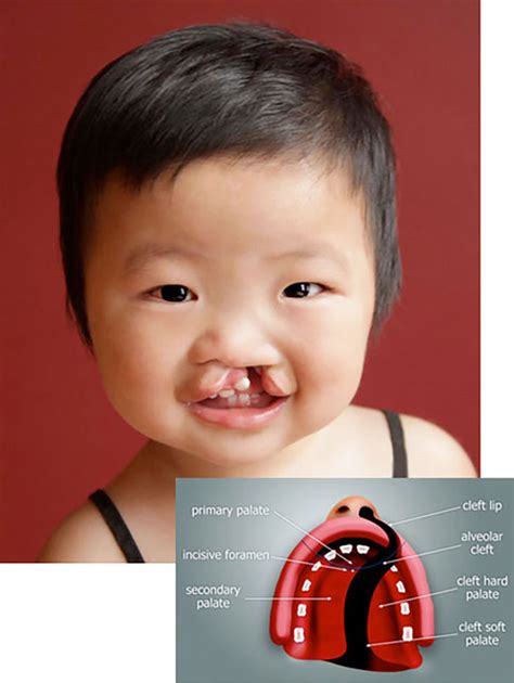 Dental Insurance for Cleft Palate Repair