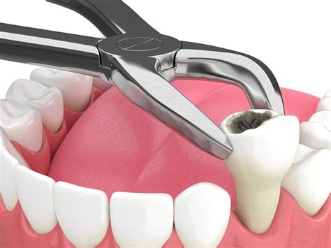 Dental Insurance for Emergency Tooth Extraction