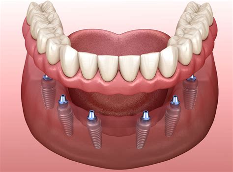 Dental Insurance for Implant-Supported Dentures