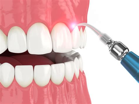 Dental Insurance for Periodontal Laser Therapy