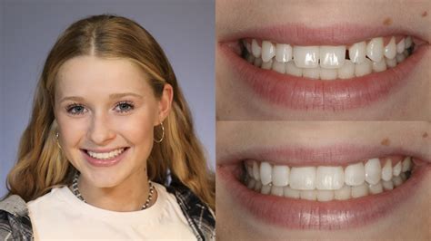 Dental Veneers after braces
