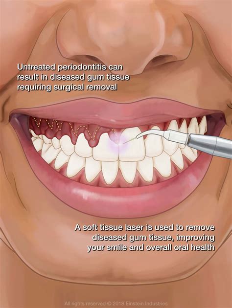Dental insurance for gum disease treatment benefits