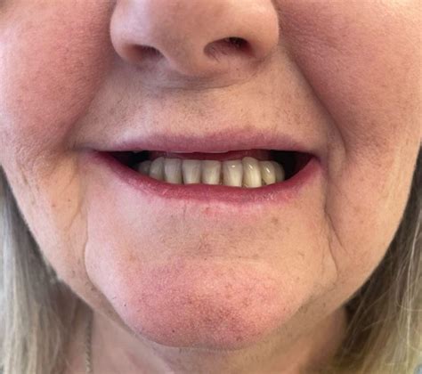 Smiling with Dentures