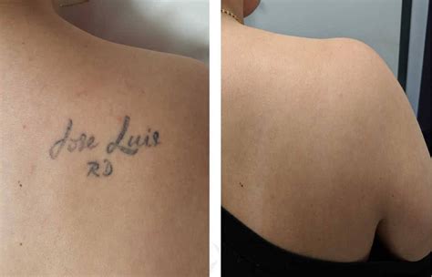 Permanent Tattoo Removal Simply Better Skin